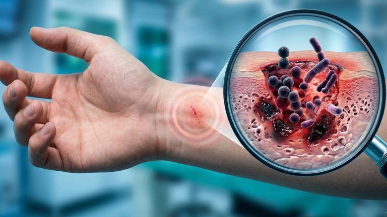 Et Yiyen Bakteri Hakkında Bilmeniz Gerekenler: Bulaşma ve Belirtiler